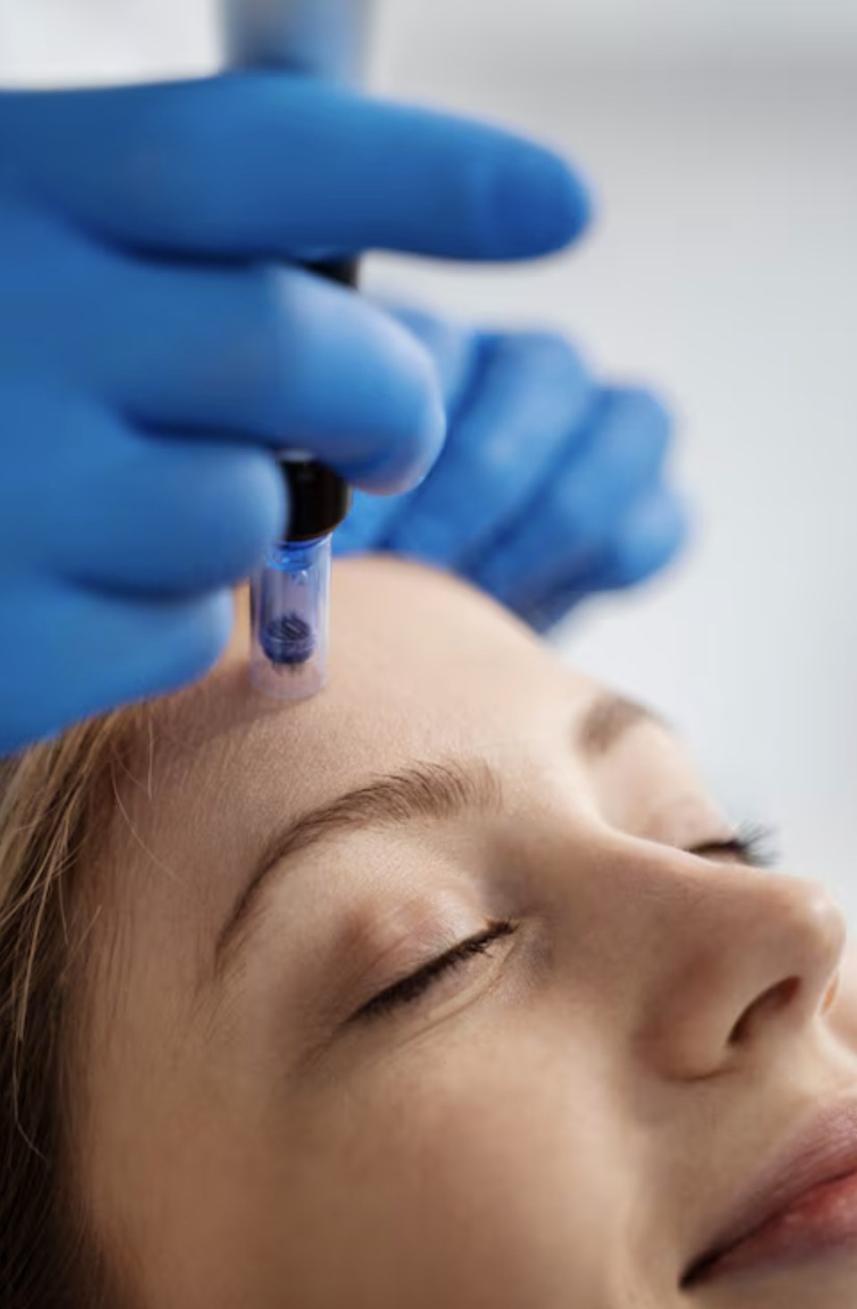 Microneedling at Palm Beach Advanced Aesthetics